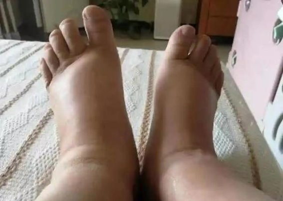 高血脂并非洪水猛兽，理性管理助力健康生活