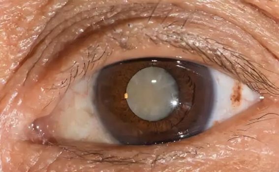 硒的力量：护眼不只是胡萝卜的事