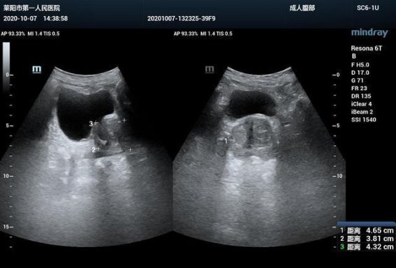 中年男性前列腺健康警示：这五种习惯要当心