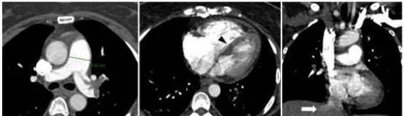 全麻下腹腔镜子宫切除术后急性肺栓塞的临床诊治