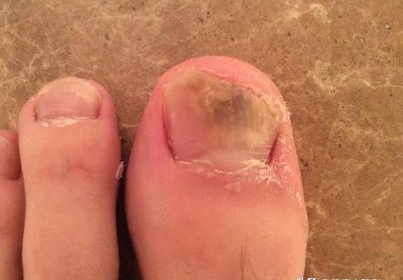 警惕！脚部这些症状可能是大病的信号