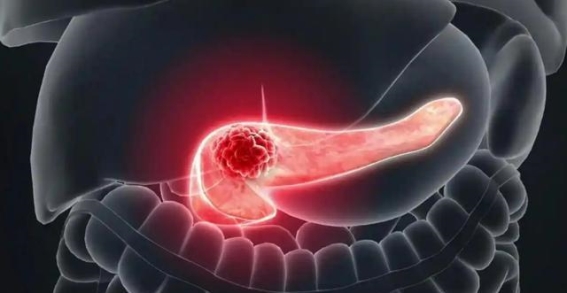 胸背痛暗示癌症信号，五大特点不可忽视