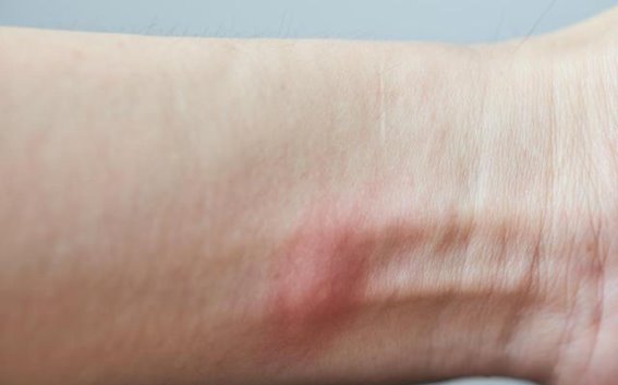 蚊子叮咬后不同反应的原因：免疫系统的作用