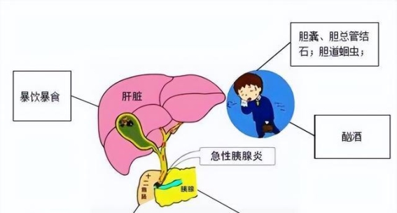 医生调查200名胰腺炎患者，揭示5大恶习