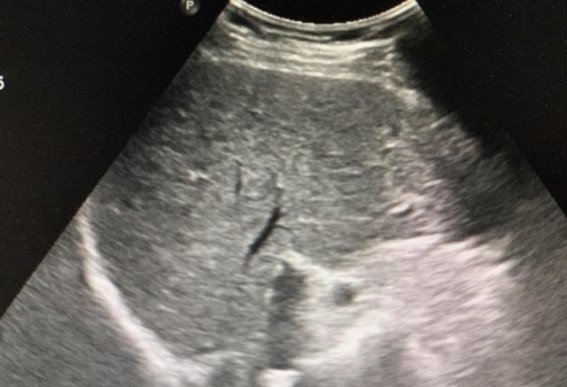 五大致命疾病的早期警示与体检的关键作用